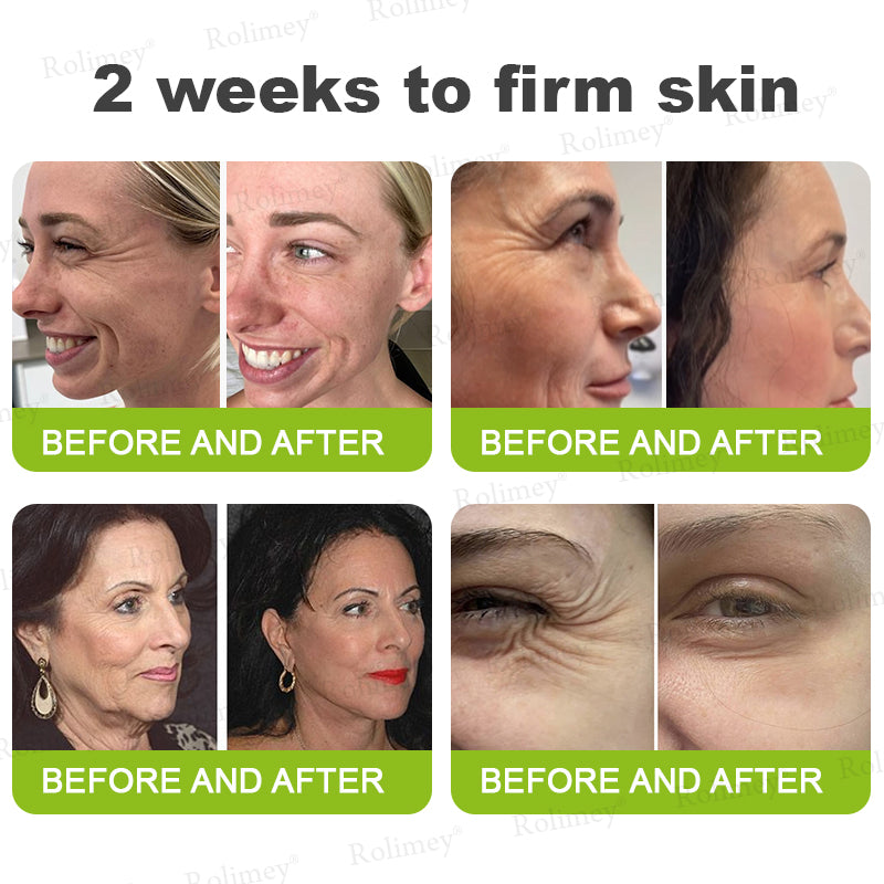 ✅💞Made and shipped from Australia 💫Rolimey® Botox & Vita-A Retinol Shot Wrinkle-Lift Tightening cream - Last Day Promotion 70% OFF