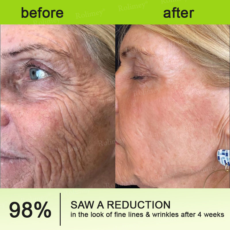 ✅💞Made and shipped from Australia 💫Rolimey® Botox & Vita-A Retinol Shot Wrinkle-Lift Tightening cream - Last Day Promotion 70% OFF