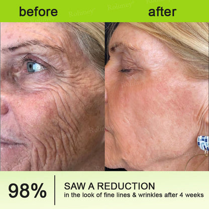 ✅💞Made and shipped from Australia 💫Rolimey® Botox & Vita-A Retinol Shot Wrinkle-Lift Tightening cream - Last Day Promotion 70% OFF