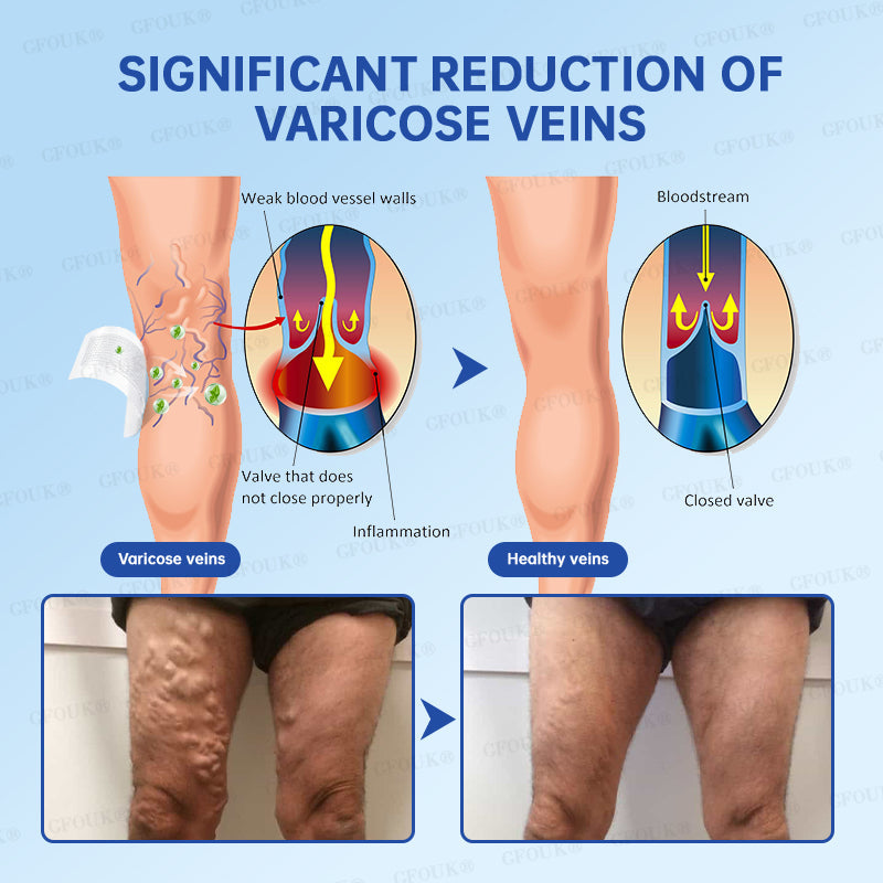 ✅GFOUK® VeinRelief Microneedle Patch ⚡Instant Relief, Long-Term Results