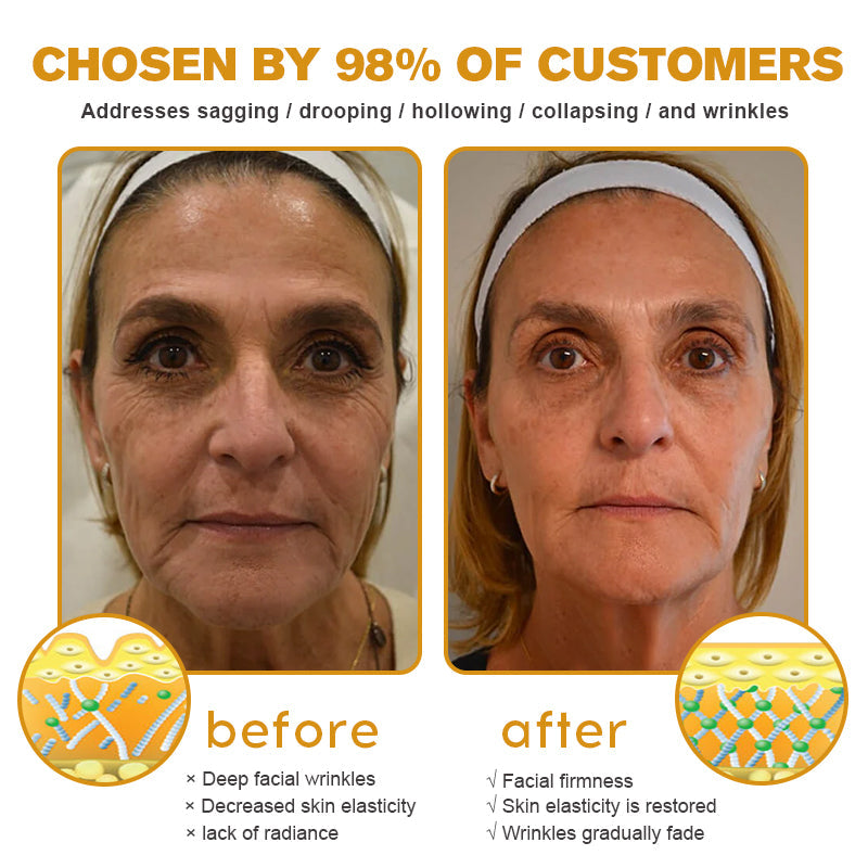 💛👨‍⚕️Made and Shipped from Australia✅ Furzero™ Botox Bee Venom Wrinkle Removal Cream- LAST DAY 70% OFF